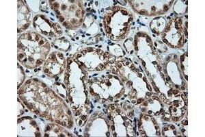 Immunohistochemical staining of paraffin-embedded Carcinoma of liver tissue using anti-LIPG mouse monoclonal antibody. (LIPG 抗体)