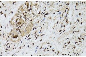 Immunohistochemistry of paraffin-embedded Human colon carcinoma using LKB1 Polyclonal Antibody at dilution of 1:100 (40x lens). (LKB1 抗体)