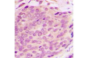 Immunohistochemical analysis of RNF125 staining in human breast cancer formalin fixed paraffin embedded tissue section. (RNF125 抗体  (Center))