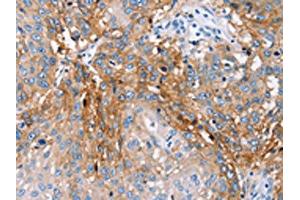 The image on the left is immunohistochemistry of paraffin-embedded Human lung cancer tissue using ABIN7130650(PLCZ1 Antibody) at dilution 1/25, on the right is treated with fusion protein. (PLCz1 抗体)