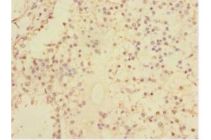 Immunohistochemistry of paraffin-embedded human breast cancer using ABIN7170630 at dilution of 1:100 (Splicing factor U2AF 26 kDa subunit (U2AF1L4) (AA 1-202) 抗体)