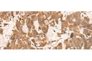Immunohistochemistry of paraffin-embedded Human thyroid cancer tissue using NRG2 Polyclonal Antibody at dilution of 1:65(x200) (Neuregulin 2 抗体)