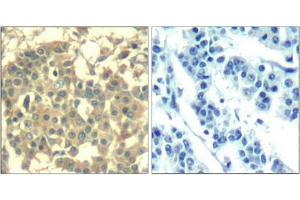 Immunohistochemical analysis of paraffin-embedded human breast carcinoma tissue using Met(Ab-1003) Antibody(left) or the same antibody preincubated with blocking peptide(right). (c-MET 抗体  (AA 1001-1005))