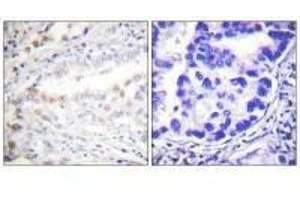 Immunohistochemistry analysis of paraffin-embedded human lung carcinoma tissue using Uba2 antibody. (UBA2 抗体  (C-Term))