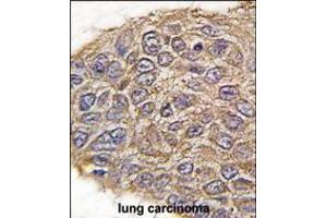 Formalin-fixed and paraffin-embedded human lung carcinoma tissue reacted with ALDOA antibody , which was peroxidase-conjugated to the secondary antibody, followed by DAB staining. (Aldolase 抗体  (N-Term))