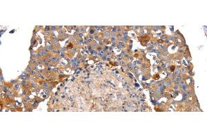 Immunohistochemistry of paraffin-embedded Human breast cancer tissue using IRS2 Polyclonal Antibody at dilution 1:100 (IRS2 抗体)