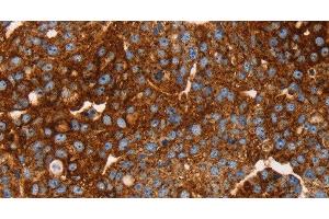 Immunohistochemistry of paraffin-embedded Human breast cancer tissue using EDAR Polyclonal Antibody at dilution 1:45 (EDAR 抗体)