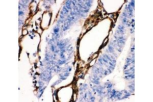 IHC-P: HSP27 antibody testing of human intestine cancer tissue (HSP27 抗体  (AA 1-205))