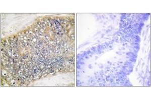 Immunohistochemistry analysis of paraffin-embedded human colon carcinoma tissue, using TALL-2 Antibody. (TNFSF13 抗体  (AA 151-200))