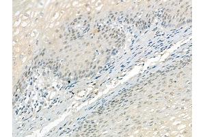 ABIN7094533 and ABIN7098582 at 1/100 staining Human esophageal cancer and adjacent normal tissues by IHC-P.