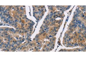 Immunohistochemistry of paraffin-embedded Human breast cancer using CBR1 Polyclonal Antibody at dilution of 1:40 (CBR1 抗体)