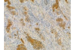 ABIN6258127 and ABIN6275841 at 1/100 staining human esophageal carcinoma by IHC-P. (DRAK2 抗体  (C-Term))