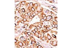 Formalin-fixed and paraffin-embedded human cancer tissue reacted with the primary antibody, which was peroxidase-conjugated to the secondary antibody, followed by AEC staining. (PIKFYVE 抗体  (Middle Region))