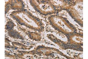 The image on the left is immunohistochemistry of paraffin-embedded Human colon cancer tissue using ABIN7190296(CLEC5A Antibody) at dilution 1/20, on the right is treated with synthetic peptide. (CLEC5A 抗体)