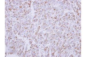 IHC-P Image Immunohistochemical analysis of paraffin-embedded U87 xenograft, using G6PD, antibody at 1:300 dilution. (Glucose-6-Phosphate Dehydrogenase 抗体)