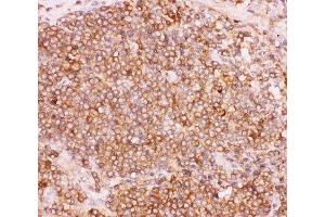 IHC-P: NFKB2 antibody testing of human lung cancer tissue (NFKB2 抗体  (AA 1-340))