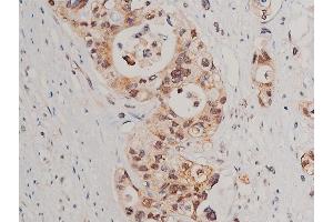ABIN6254994 and ABIN6267520 at 1/50 staining human colon cancer tissue sections by IHC-P.