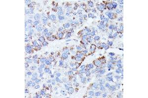 Immunohistochemistry of paraffin-embedded human liver cancer using CCDC6 antibody (ABIN7266442) at dilution of 1:100 (40x lens). (CCDC6 抗体  (AA 55-222))