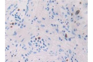 DAB staining on IHC-P; Samples: Human Lung cancer Tissue (CCL26 抗体  (AA 24-94))