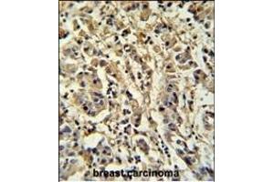 Sirt3 Antibody (C-term) (ABIN652184 and ABIN2840670) IHC analysis in formalin fixed and paraffin embedded human breast carcinoma followed by peroxidase conjugation of the secondary antibody and DAB staining. (SIRT3 抗体  (C-Term))