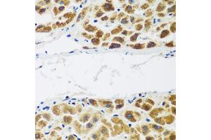 Immunohistochemistry of paraffin-embedded human liver cancer using NAA60 antibody (ABIN5975517) at dilution of 1/200 (40x lens). (NAT15 抗体)