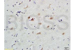 Formalin-fixed and paraffin embedded human colon carcinoma labeled with Anti-Caspase-9 Polyclonal Antibody, Unconjugated (ABIN724160) 1:200 followed by conjugation to the secondary antibody and DAB staining