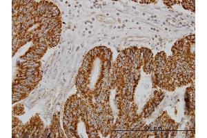 Immunoperoxidase of monoclonal antibody to SH3BP5 on formalin-fixed paraffin-embedded human colon adenocarcinoma. (SH3BP5 抗体  (AA 4-112))