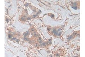 Detection of PKBg in Human Breast cancer Tissue using Polyclonal Antibody to Protein Kinase B Gamma (PKBg) (AKT3 抗体  (AA 46-338))
