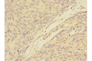 Immunohistochemistry of paraffin-embedded human ovarian cancer using ABIN7144788 at dilution of 1:100 (Ataxin 1 抗体  (AA 346-475))