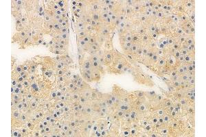 ABIN6263854 and ABIN6272769 at 1/100 staining human hepatocellular carcinoma by IHC-P.