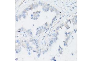 Immunohistochemistry of paraffin-embedded Human lung adenocarcinoma (negative control sample) using p63 Rabbit mAb (ABIN7271099) at dilution of 1:100 (40x lens). (p63 抗体)