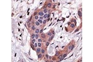 IHC analysis of FFPE human breast carcinoma tissue stained with the Bid antibody (BID 抗体  (AA 68-103))