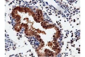 Immunohistochemical staining of paraffin-embedded Adenocarcinoma of Human endometrium tissue using anti-QPRT mouse monoclonal antibody. (QPRT 抗体)