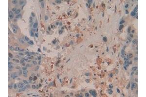 Detection of mTOR in Human Breast cancer Tissue using Polyclonal Antibody to Serine/threonine-protein kinase mTOR (mTOR)