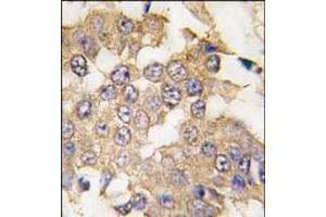 Formalin-fixed and paraffin-embedded human breast carcinoma tissue reacted with ERK2 antibody (C-term), which was peroxidase-conjugated to the secondary antibody, followed by DAB staining. (ERK2 抗体  (C-Term))