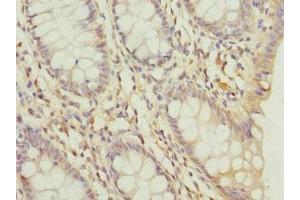 Immunohistochemistry of paraffin-embedded human colon cancer using ABIN7164341 at dilution of 1:100 (DDX2 (AA 25-280) 抗体)