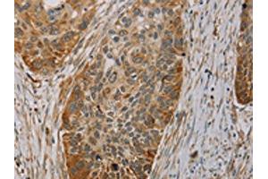 The image on the left is immunohistochemistry of paraffin-embedded Human esophagus cancer tissue using ABIN7130527(PAGE2 Antibody) at dilution 1/20, on the right is treated with fusion protein. (PAGE2 抗体)