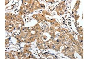 The image on the left is immunohistochemistry of paraffin-embedded Human lung cancer tissue using ABIN7192673(STEAP4 Antibody) at dilution 1/25, on the right is treated with synthetic peptide. (STEAP4 抗体)