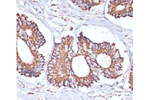 Immunohistochemistry of paraffin-embedded Human colon carcinoma using UBE2O Polyclonal Antibody at dilution of 1:100 (40x lens). (UBE2O 抗体)