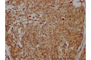 IHC image of ABIN7127675 diluted at 1:100 and staining in paraffin-embedded human cervical cancer performed on a Leica BondTM system. (Recombinant PELP1 抗体)