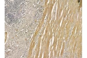 ABIN6263923 and ABIN6273281 at 1/100 staining human colon carcinoma by IHC-P.