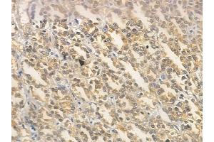 ABIN6259644 and ABIN6266603 at 1/100 staining human renal cell carcinoma by IHC-P.