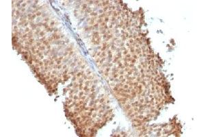 IHC testing of bladder carcinoma stained with Estrogen Receptor beta antibody (ERb455).