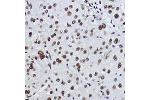 Immunohistochemistry of paraffin-embedded human liver cancer using EXOSC7 Rabbit mAb (ABIN7267064) at dilution of 1:100 (40x lens). (EXOSC7 抗体)