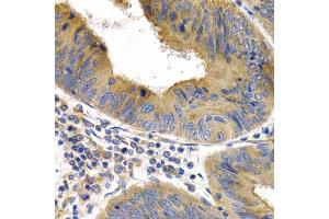 Immunohistochemistry of paraffin-embedded human colon cancer using HSPB8 antibody (ABIN5971347) at dilution of 1/200 (40x lens). (HSPB8 抗体)