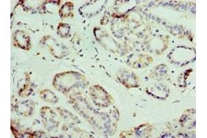 Immunohistochemistry of paraffin-embedded human breast cancer using ABIN7176713 at dilution of 1:100 (SLC39A6 抗体  (AA 170-320))