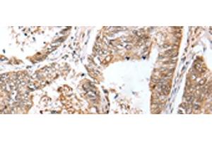 Immunohistochemistry of paraffin-embedded Human colorectal cancer tissue using LRRC19 Polyclonal Antibody at dilution of 1:30(x200) (LRRC19 抗体)