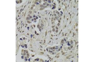 Immunohistochemistry of paraffin-embedded human breast cancer using INTS6 Antibody. (INTS6 抗体)