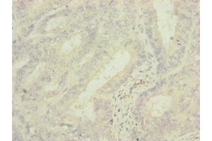 Immunohistochemistry of paraffin-embedded human endometrial cancer using ABIN7142279 at dilution of 1:100 (MRPS6 抗体  (AA 1-125))