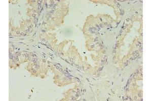 Immunohistochemistry of paraffin-embedded human prostate cancer using ABIN7142322 at dilution of 1:100 (ACAA1 抗体  (AA 27-331))